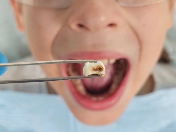 Best Emergency Dentist for Lost Fillings or Crowns in Marietta, PA